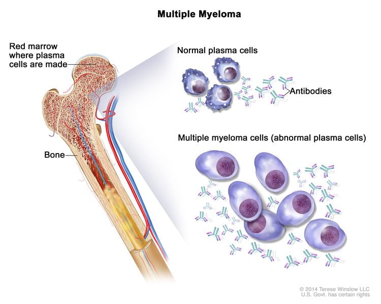 multiple myeloma bone marrow biopsy results